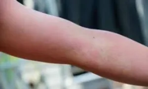 Giải mã 'cơn bão' mề đay sau sinh